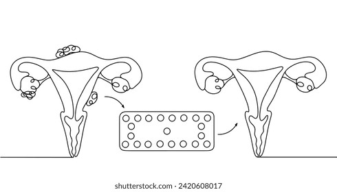 Tratamiento de la endometriosis con medicamentos hormonales. Anticonceptivos orales como tratamiento terapéutico. Ilustración vectorial. Imágenes producidas sin el uso de ningún tipo de software de IA en cualquier etapa. 