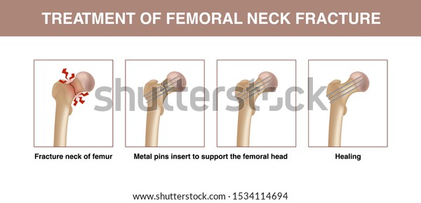 Treatment Femoral Neck Fracture Vector Illustration Stock Vector ...