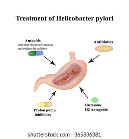 Treatment of Helicobacter pylori. Medications. Antacids, proton pump blockers and H2-histamine blockers. Infographics. Vector illustration on isolated background.