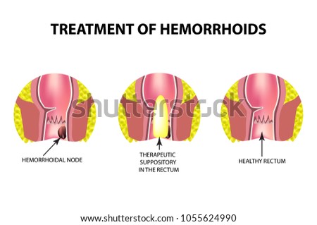 Treatment of hemorrhoids with suppositories. Infographics. Vector illustration on isolated background.