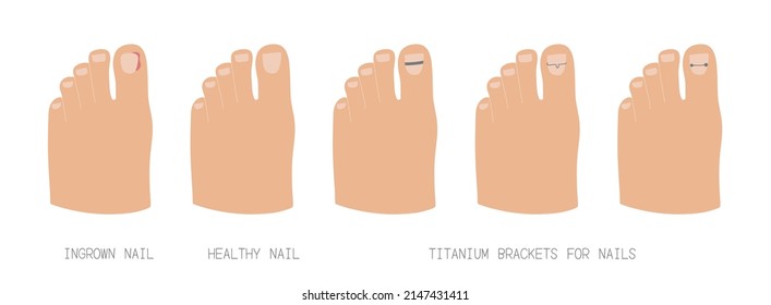 Treatment of ingrown toenail with titanium brackets different types. Hand drawn vector illustration.Isolated elements on white background