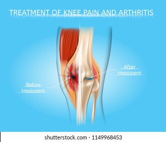 Treatment Of Knee Pain And Arthritis Realistic Vector Medical Poster Or Scheme With Damaged By Disease And Healthy Human Knee Joint Before And After Treatment, Anatomical Cross Section Illustration