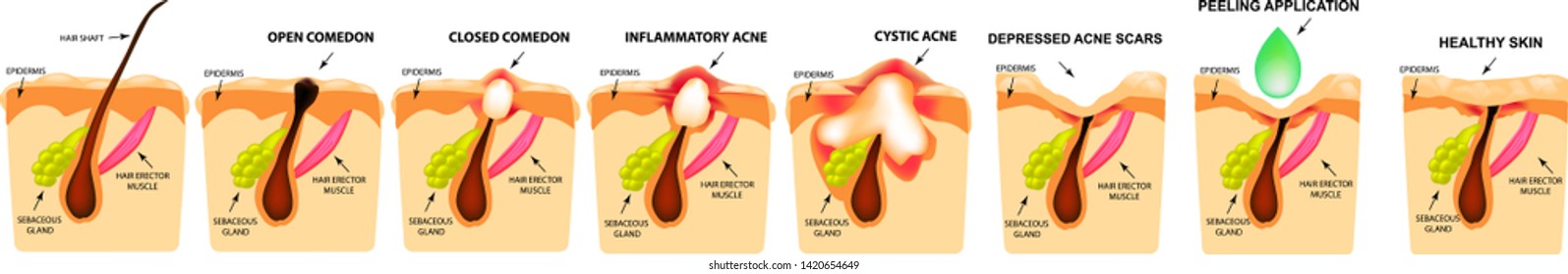 Treatment of open comedones, inflamed acne, acne cysts. Sore acne. The structure of the skin. Treatment of scars of acne and pimples. Peeling. Infographics. Vector illustration on isolated background.