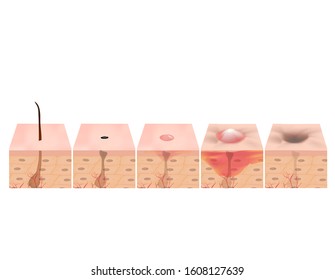 Treatment of open comedones, inflamed acne, acne cysts. Sore acne. structure of the skin. Treatment of scars of acne and pimples. blackheads. Infographics. Vector illustration on isolated background.