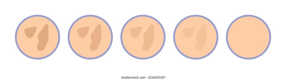 Tratamiento de puntos pigmentarios. Problema de la piel. Edad Puntos Marrones Oscuros. Pasos. Antes y después. Extracción de la pigmentación de la piel. Estilo de dibujos animados de color. Fondo blanco. Ilustración vectorial para el diseño médico de belleza