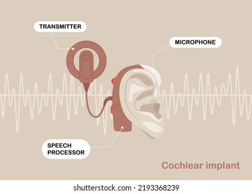 Treatment And Prosthetics Of Hearing Loss In Otolaryngology. Cochlear Hearing Aids Behind The Ear, On Background Of Sound Wave Diagram.