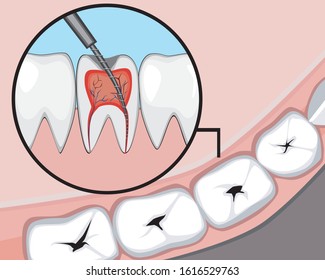 Treatment of pulpitis or caries in a dental or orthodontic clinic. Vector stock illustration with problems with molars. Toothache and nerve removal concept