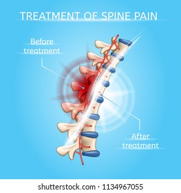 Treatment of Spine Pain Realistic Vector Poster or Chart with Damaged and Healthy Vertebral Column Before and After Medical Procedures Illustration. Human Body Joints Injuries Healing Medical Scheme
