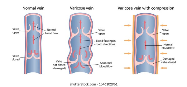 Treatment of varicose veins by compression. The scheme of venous circulation with normal and varicose veins. A longitudinal section of a vein with a description of the main parts. Vector illustration