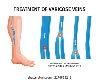 Treatment Of Varicose Veins Infographics Poster Depicting Heating And Narrowing Of Vein With Laser Catheter Realistic Vector Illustration