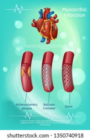 Treatment and Warning Hearts Disease Methods Banner. Vector Illustration Realistic Blood Vessels, Atherosclerotic Plaques Prevention Myocardial Infarction Balloon Catheter, Stent. Healthcare concept