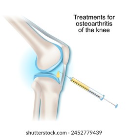 Tratamientos para la artrosis de la articulación de la rodilla. Jeringa e inyección intraarticular. Ilustración vectorial.