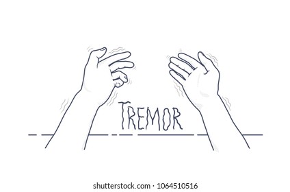 Tremor Hands. First-person View Of Shaking Hands. Symptom Of Parkinson's Disease. Medical Vector Illustration, Isolated On White Background.