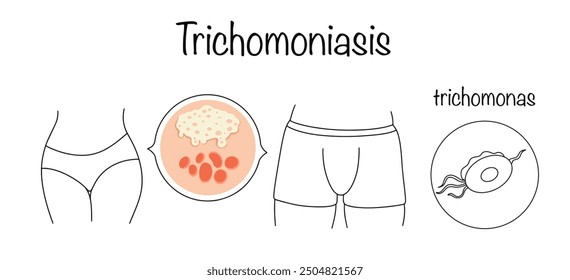 Trichomoniasis. A disease of the human genitourinary system caused by the protozoan single-celled parasite Trichomonas vaginalis. Venereal disease, its causative agent and consequences. Vector.