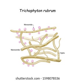 Trichophyton rubrum is a dermatophytic fungus that colonizes the upper layers of skin and cause of fungal infection of nail. Close-up of fungi with fertile hyphae, Macroconidia and Microconidia