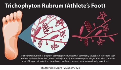 Trichophyton Rubrum fungal infection illustration