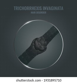 Trichorrhexis invaginata damaged hair surface under microscope. Bamboo hair follicle brittle condition closeup trichoscopy vector. Problem of fragility and breakage. Trichology medical concept.