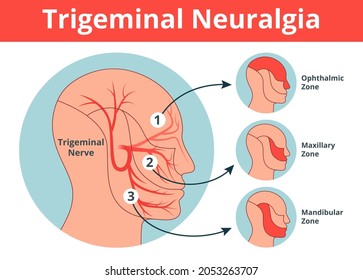 Trigeminal Nerve anatomy. Trigeminal Neuralgia with pain areas. Simple vector anatomy illustration in flat style.