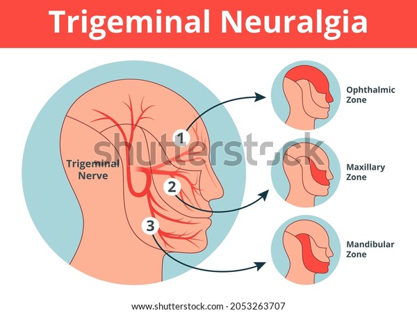 Trigeminal Nerve\
anatomy. Trigeminal Neuralgia with pain areas. Simple vector\
anatomy illustration in flat\
style.