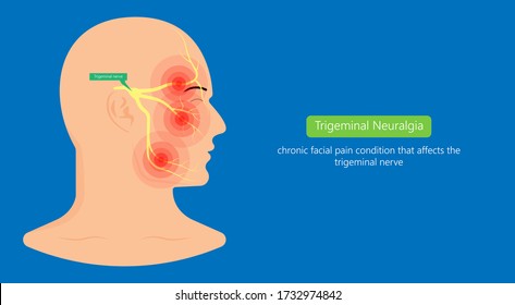 Trigeminal neuralgia chronic pain of facial TMD injury ophthalmic maxillary mandibular sensation central nervous system immune attacks myelin