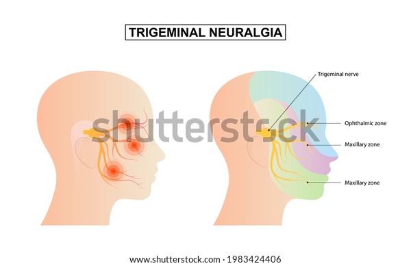 Trigeminal neuralgia chronic pain of facial TMD\
injury ophthalmic maxillary mandibular sensation. Trigeminal nerve\
anatomy.