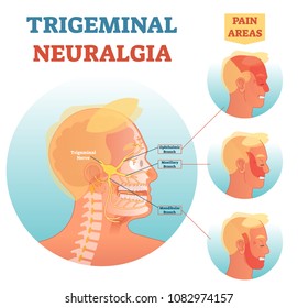 Trigeminal neuralgia medical cross section anatomy vector illustration diagram with facial neural network and pain areas.Head neurology scheme with ophthalmic, maxillary and mandibular branches.
