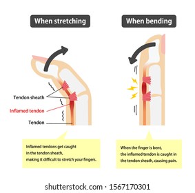 Trigger finger causes and symptoms illustration / English (with explanation texts)