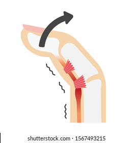 Trigger finger causes and symptoms illustration / when stretching