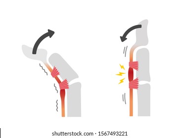 Trigger finger causes and symptoms illustration / No text