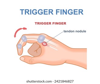 Trigger finger concept. Medical infographics and educational materials. Biology and anatomy. Graphic element for website. Cartoon flat vector illustration isolated on white background