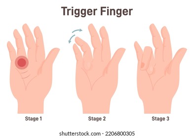 Trigger finger or finger lock. Disease causing pain, stiffness, and a sensation of locking or catching of the finger. Bended ring finger. Flat vector illustration svg
