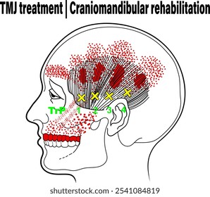 Trigger Point Diagram, TMJ treatment, Craniomandibular rehabilitation