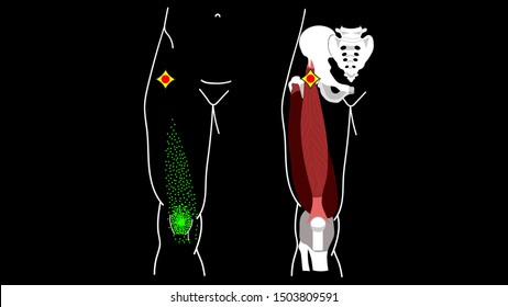 Trigger Point Rectus femoris muscle