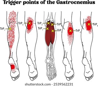 Trigger points  diagram, Trigger points of the Gastrocnemius