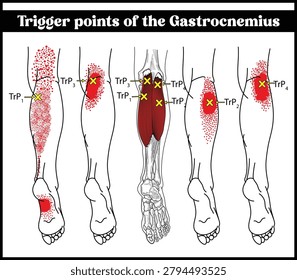 Trigger points diagram, Trigger points of the Gastrocnemius