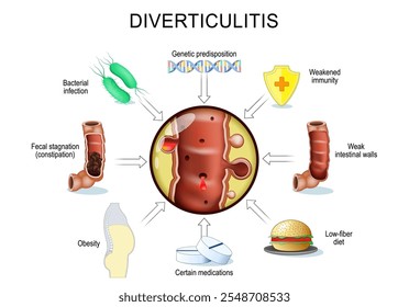 Desencadeadores de progressão de diverticulite. Peristaltismo gastrointestinal e obstipação crônica. Distúrbios da motilidade intestinal. Close de uma parte do intestino grosso com Divertículos