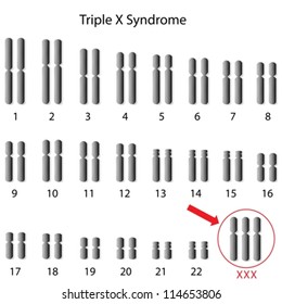 Triple X syndrome