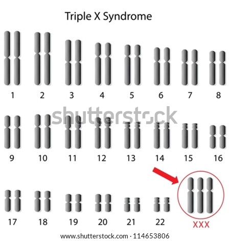 Triple X syndrome