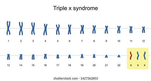 Triple x syndrome