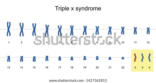 Triple X Syndrome Karyotype Nondisjunction Sex Stock Vector Royalty Free 1427362853 3375