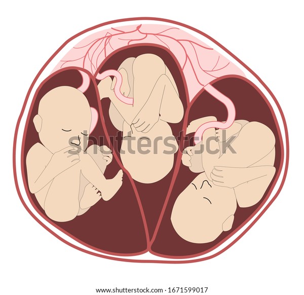 子宮内の三つ子 子宮内の三つの胎児 複数の妊娠 危険因子 羊水嚢を分離し 1つの胎盤 3本の臍帯 白い背景にベクター画像メディカルイラスト のベクター画像素材 ロイヤリティフリー