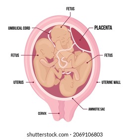 Triplets In Uterus. Three Fetuses In The Womb. Multiple Pregnancy. One Amniotic Sac. Risk Factor. Three Umbilical Cords. Vector Medical Diagram With Terms Isolated On White Background