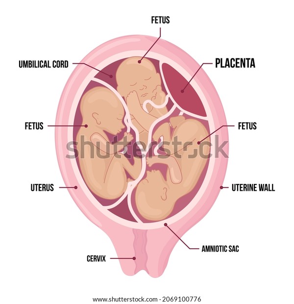 triplets\
in uterus. three fetuses in the womb. Multiple pregnancy. Separate\
amniotic sac. risk factor. Three umbilical cords. Vector medical\
diagram with terms isolated on white\
background