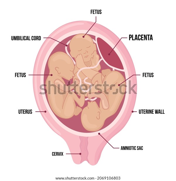 triplets\
in uterus. three fetuses in the womb. Multiple pregnancy. One\
amniotic sac. risk factor. Three umbilical cords. Vector medical\
diagram with terms isolated on white\
background