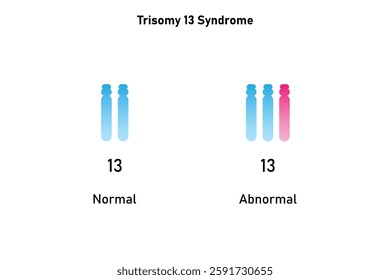 Trisomy 13 Syndrome Science Design. Vector Illustration.