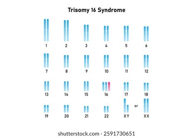 Trisomy 16 Syndrome Science Design. Vector Illustration.