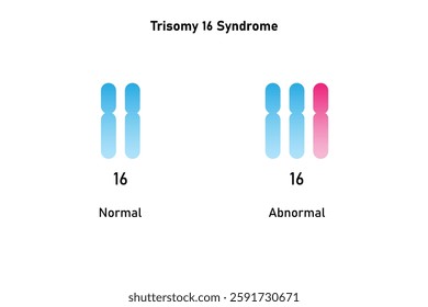 Trisomy 16 Syndrome Science Design. Vector Illustration.