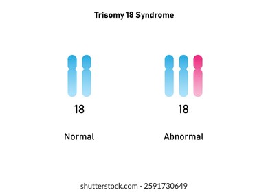 Trisomy 18 Syndrome Science Design. Vector Illustration.