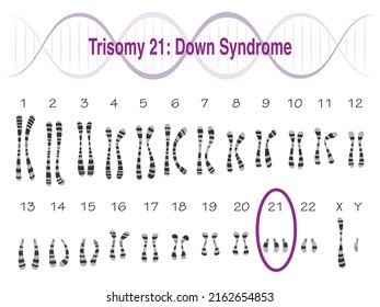 Trisomy 21 Down Syndrom Karyotype