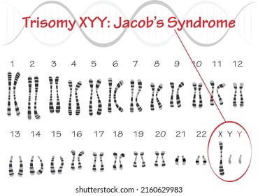 Jacob Syndrome Karyotype